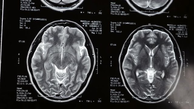 Doctor examines x-ray of brain in patient