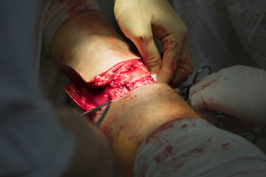 Human leg amputation surgery close-up with wide open cut and visible tissues