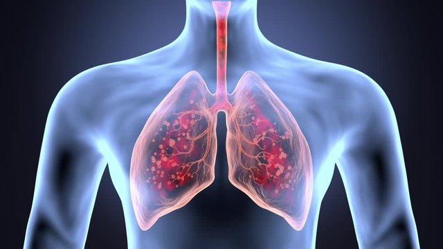 Coronavirus attacks human lungs and causes pneumonia. Lung infection - covid-19, vcov 2019. Microscope virus close up - 3d render animation.