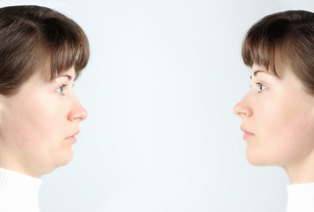 Profile of female face with and without a second chin, concept before and after plastic surgery