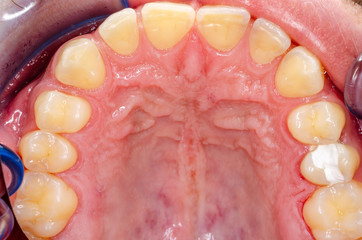signs of teeth grinding on upper incisors © Dirk