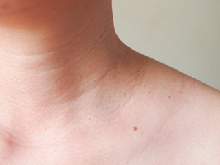 Close-up the skin tags on neck woman skin.
