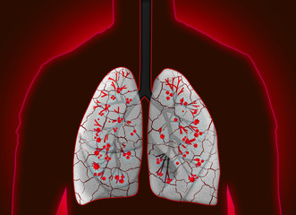 Man with diseased lungs on red background. Illustration
