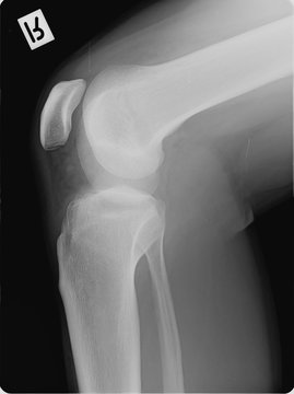 X-Ray image of a right bent leg including knee cap