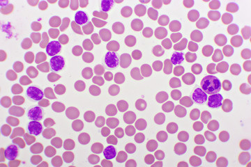 Picture of acute lymphocytic leukemia or ALL cells in blood smear, analyze by microscope, 1000x