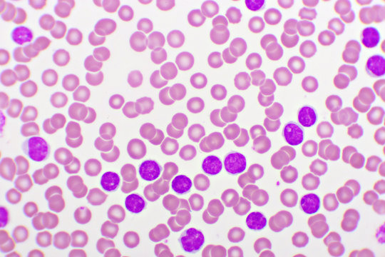 Picture of acute lymphocytic leukemia or ALL cells in blood smear, analyze by microscope, 1000x