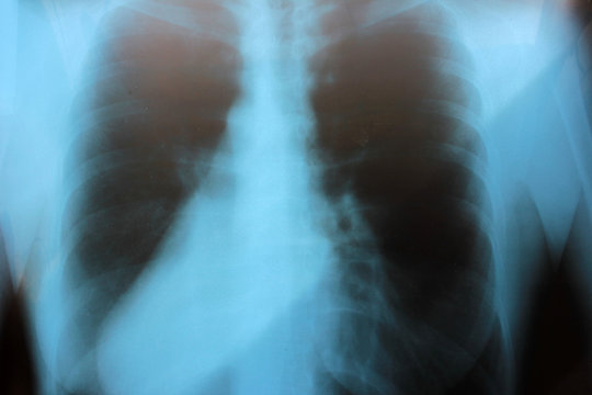 Close-up of healthy human lung x-ray. Lung inflammation, tuberculosis, coronavirus were not detected. X-ray image of woman chest