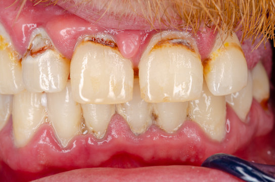 gingivitis and tooth decay