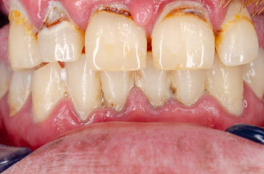 gingivitis and tooth decay