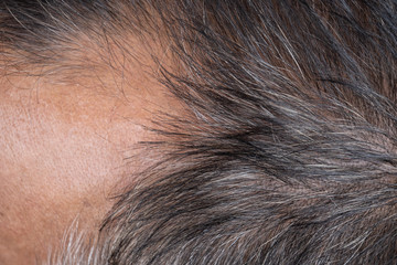 Close up of head Asian man lose one's hair.