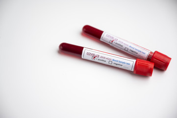 Blood test samples for presence of coronavirus (COVID-19) tube containing a blood sample that has tested positive for coronavirus.