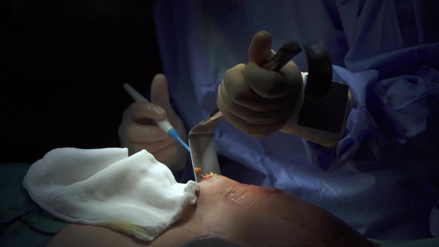 Crop surgeon performing mammoplasty in clinic