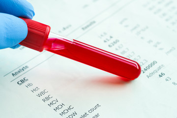 Blood samples and blood test results of the disease Coronavirus Covid 19.New epidemic prevention concept