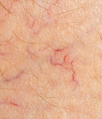Spider veins, dilated blood vessels