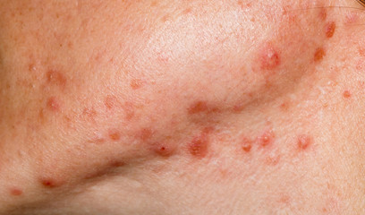 Nodulocystic acne on human skin