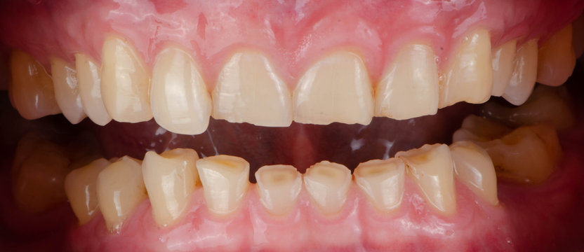 The chipped and worn teeth