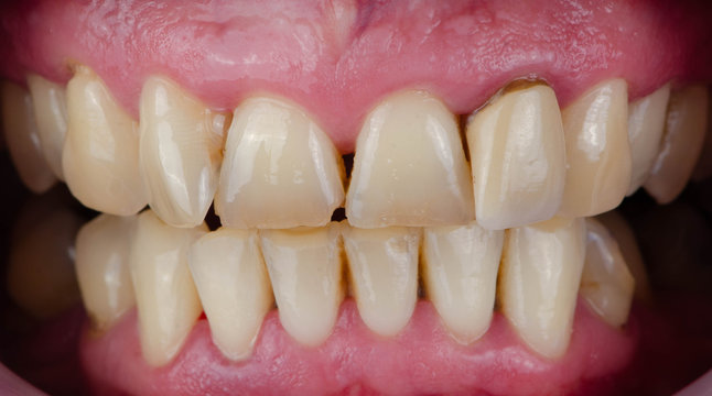 The chipped and worn teeth