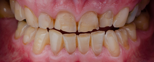 the broken and worn teeth