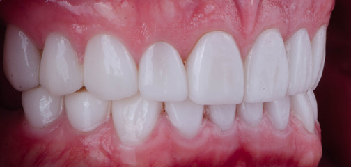 The Hollywood smile and healthy gum