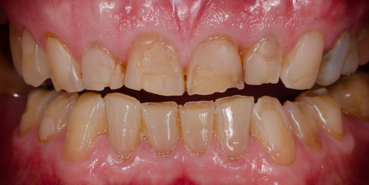 The worn and lost teeth because of hard biting