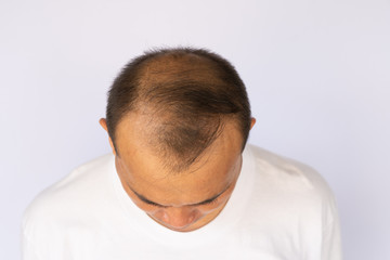 Obraz premium An Asian man with hair loss