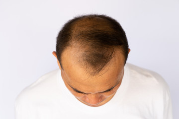 Obraz premium Hair loss Asian man showing all side of his bald head