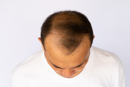 Hair loss Asian man showing all side of his bald head