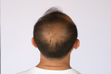 Hair loss Asian man showing all side of his bald head