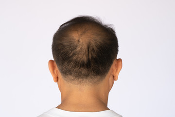 Fototapeta premium An Asian man with hair loss