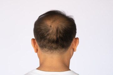 An Asian man with hair loss