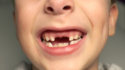 6 years kid showing missing teeth, he has lost two calfs teeth. Close up portrait of blonde caucasian boy smiling demonstrating white teeth without two front teeth.