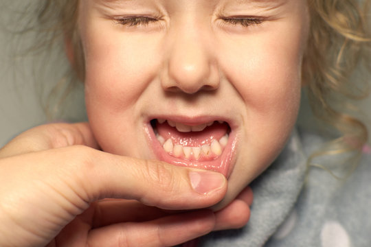 Close up of unhealthy baby teeth. Dental medicine and healthcare - kid open mouth showing caries teeth decay, bad teeth.