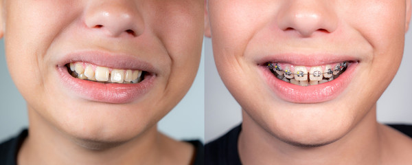 Close up view collage photography of smiling mouth of young white kid with overbite teeth before and after fixing metal modern braces construction on teeth. Shoot the same day. - obrazy, fototapety, plakaty