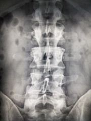 Fototapeta premium X-ray of the human spine