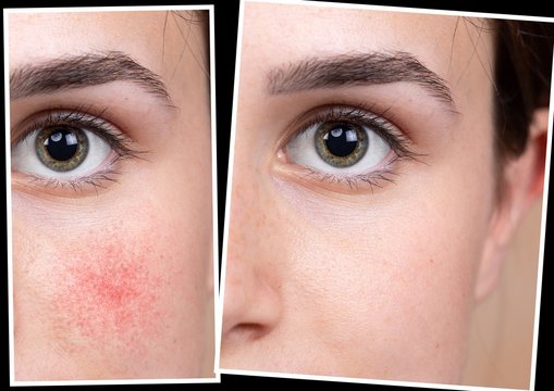 Collage comparison healthy skin and skin suffering rosacea. Young female face closeup. Medicine and health care concept...
