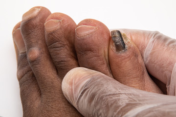 Close up of black man toes. Hand holding little toenail damaged and deformed by fungal infection....