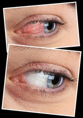 Comparison closeup view of eye before and after eyedrop treatment. Female red irritated eye....