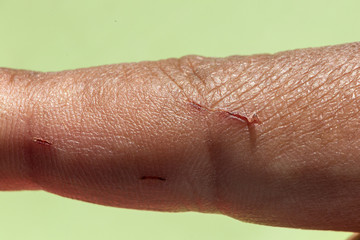 Closeup of fresh wound on human finger skin. Mechanical accidents caused injury. Medical, personal...