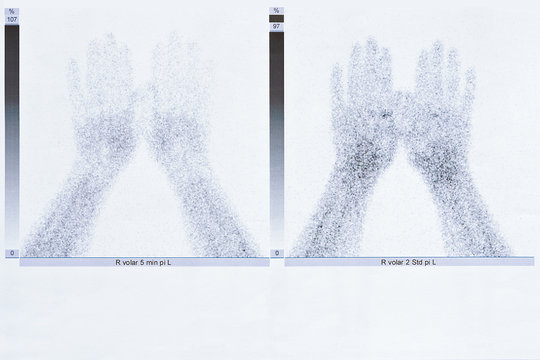 Bone scintigraphy or scintigram of the hands of a 50 year old woman, showing degenerative joint disease