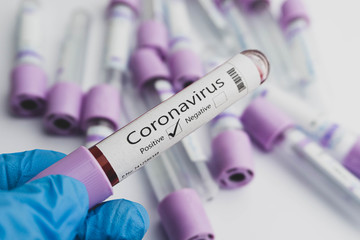 Blood test samples for presence of coronavirus (COVID-19) tube containing a blood sample that has tested positive for coronavirus. Covid-19 concept.