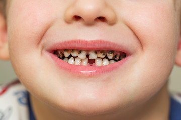 Kid patient open mouth showing cavities teeth decay. Teeth health care