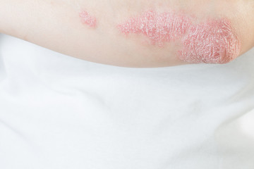 Acute psoriasis on elbows is an autoimmune incurable dermatological skin disease. Large red, inflamed, flaky rash on the knees. Joints affected by psoriatic arthritis.