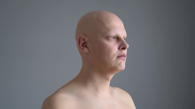 Sad sick man with brain cancer. Close-up face rotates in front of the camera.