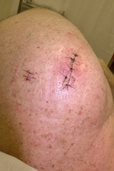 Scar with sutures after shoulder surgery of a senior man in Cairns, Queensland, Australia