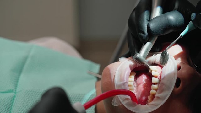 Tooth treatment. Female patient treating her tooth at the dentist's office. Hands of stomatologist working with dental tools in the woman's mouth. Close-up.