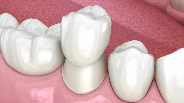 Preparated premolar tooth for dental ceramic crown placement. Medically accurate  3D animation