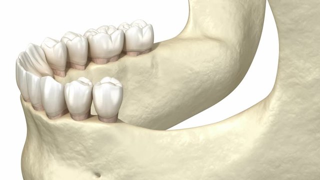 Cleavage of the alveolar ridge, augmentation, implantation. Dental surgery, 3D animation.