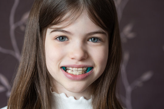 Little girl shows orthodontic apparatus in the mouth, malocclusion, pediatric orthodontics