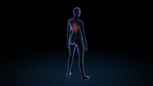 Girl with pathology. 3d body of women. Female human figure.