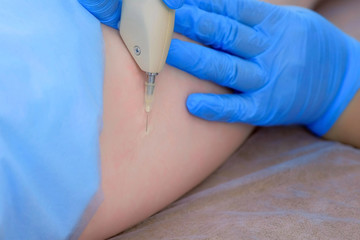 Doctor is making injection of carbon dioxide on patient's hip, leg on carboxytherapy, body closeup. Doctor woman using special apparatus. Treatment and remove of skin tags and stretches.
